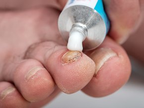 Aplikacja maści na paznokieć dotknięty grzybicą