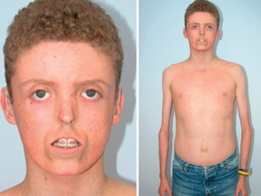 Lipodystrofia