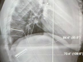 Choroba Scheuermanna – przyczyny, objawy, badania, leczenie, operacja, rehabilitacja, ćwiczenia