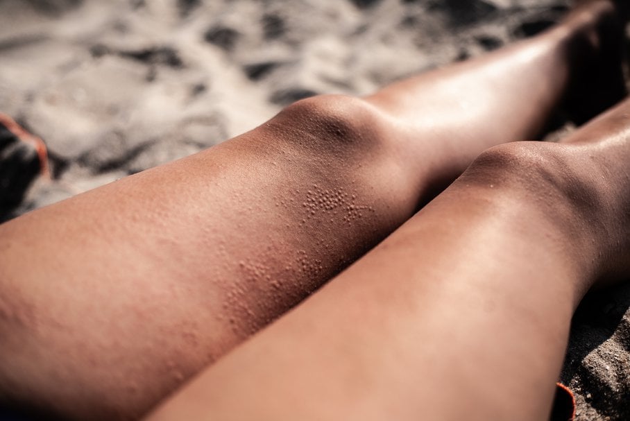 Alergia na słońce – jakie są objawy uczulenia na słońce i jak wygląda leczenie?