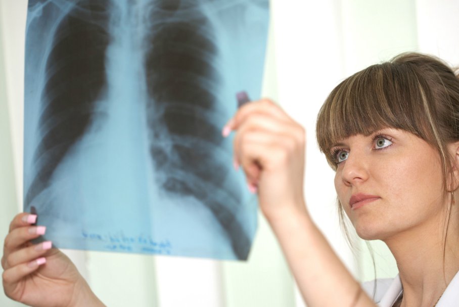Atypowe zapalenie płuc – przyczyny, objawy, leczenie antybiotykiem