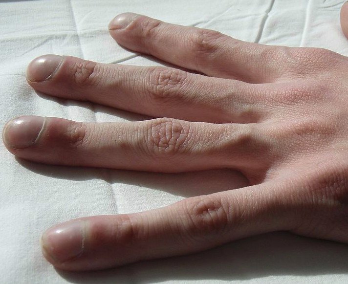 Palce pałeczkowate – przyczyny, objawy, leczenie