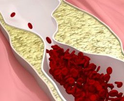 Cholesterol a miażdżyca tętnic – jaki jest związek?