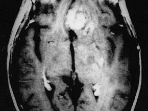 Glejak wielopostaciowy (glioblastoma) – objawy, leczenie, rokowania