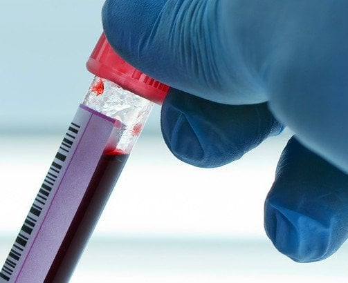 Test na HIV - co warto wiedzieć?