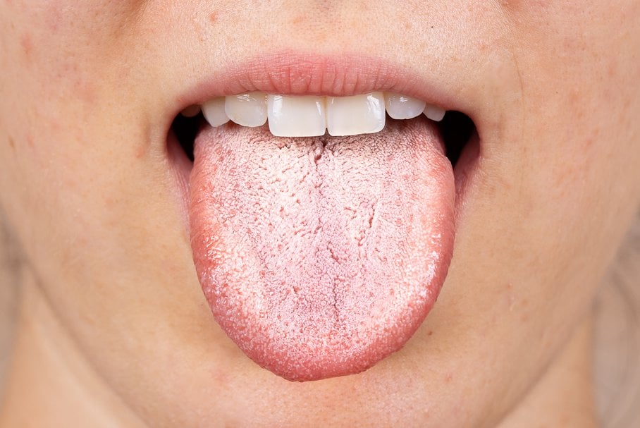 Kobieta z drożdżycą jamy ustnej pokazująca język.
