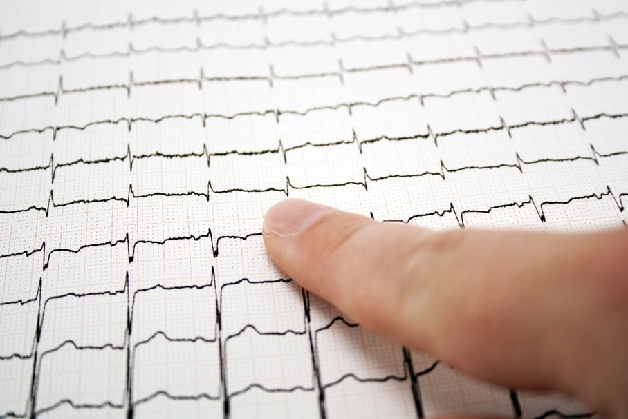 Zaburzenia rytmu serca – rodzaje, przyczyny, objawy, leczenie