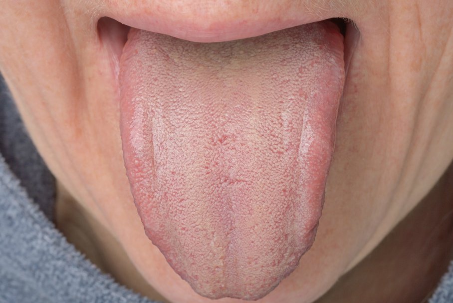 Choroby języka – rodzaje, objawy, leczenie