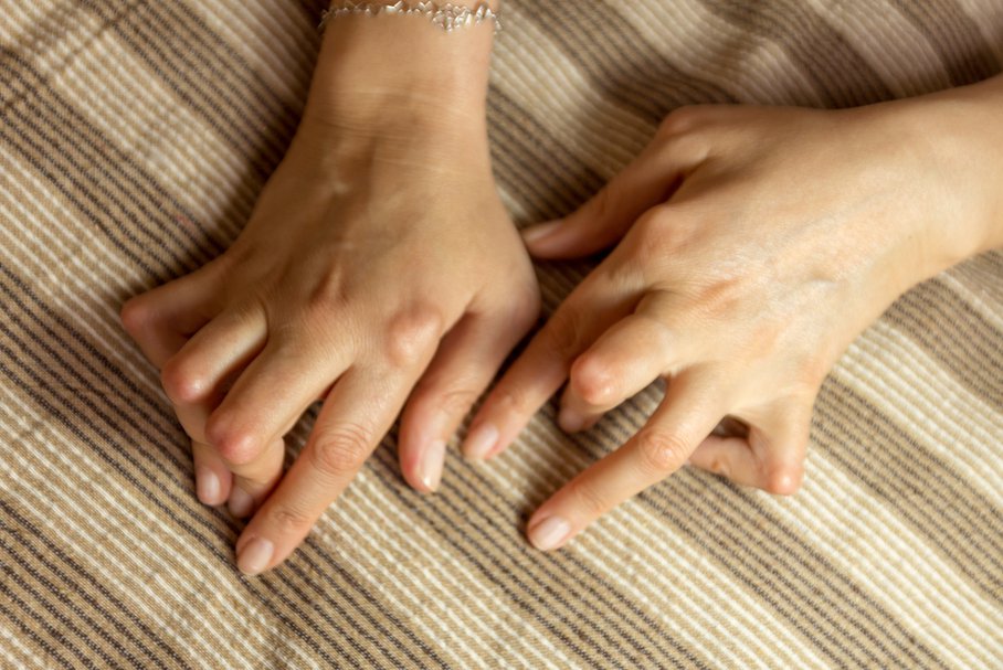 Dłonie kobiety cierpiącej na reumatoidalne zapalenie stawów.