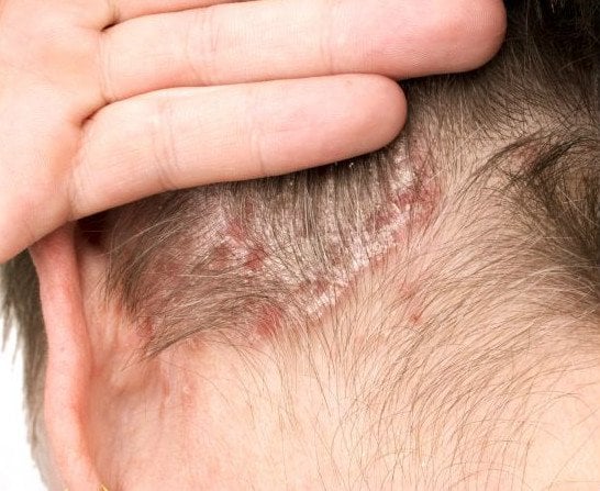Łuszczyca głowy – przyczyny, objawy i leczenie łuszczycy skóry głowy