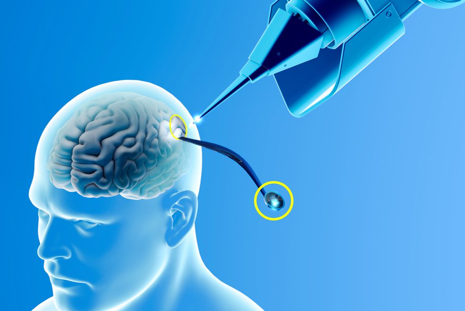 Wszczepienie implantu mózgowego Neuralink.