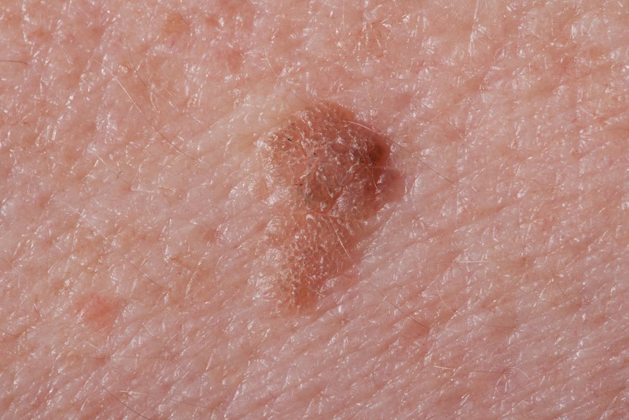 Brązowe plamy na skórze – co oznaczają przebarwienia na ciele?