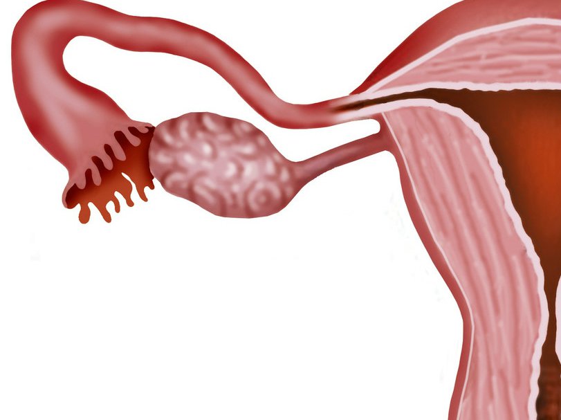 Polip endometrialny – przyczyny, objawy, badania, leczenie
