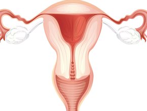 Zespół Ashermana – przyczyny, objawy, diagnostyka i leczenie