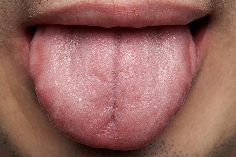 Poparzony język