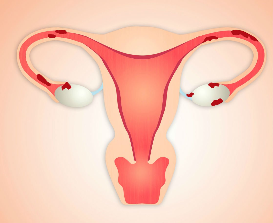 Chirurgiczne I Hormonalne Leczenie Endometriozy Wylecz To