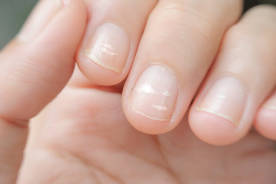 bruzdy na paznokciach jakie są przyczyny pofalowanej płytki paznokcia