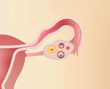 Guzy jajnika – guzy hormonalne na jajniku