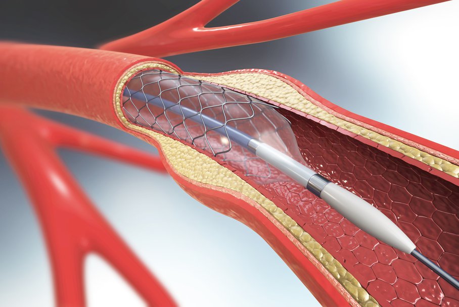 Przezcewnikowe wszczepienie zastawki aortalnej