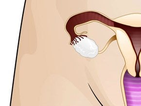 Torbiel endometrialna – objawy, torbiel a ciąża, leczenie