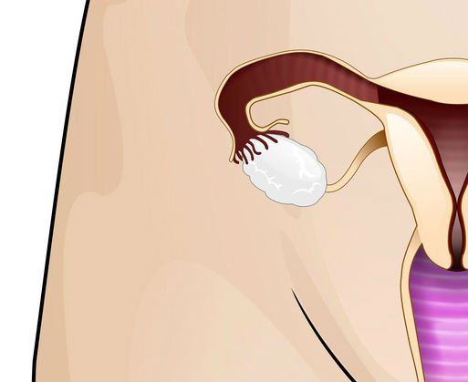 Torbiel endometrialna – objawy, torbiel a ciąża, leczenie