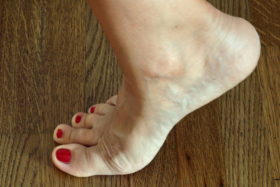 Hiperkeratoza stóp i paznokci
