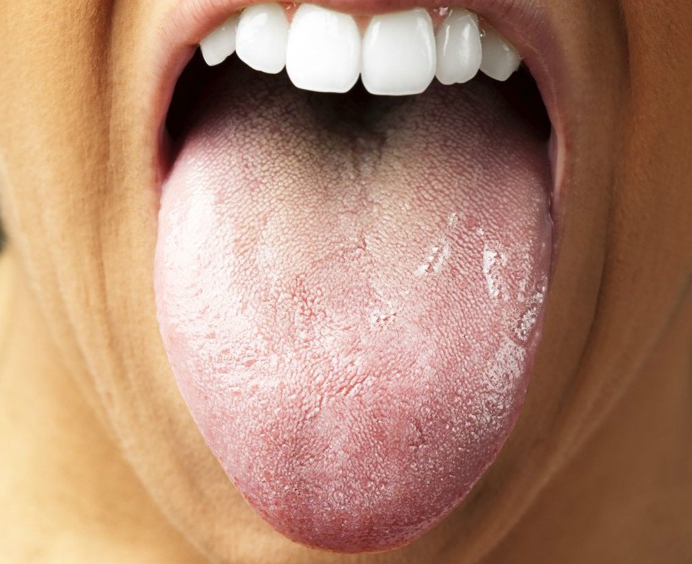 Zmiany W Jamie Ustnej Przyczyny Objawy Leczenie Zmian W Ustach Wylecz To