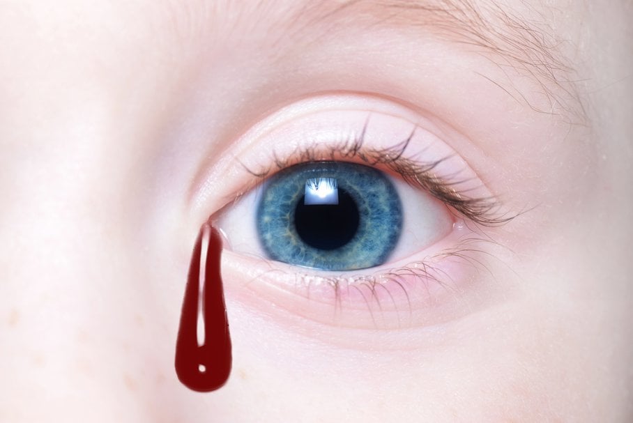 Hemolakria – czego objawem są krwawe łzy?
