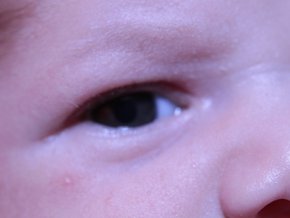 retinopatia wcześniacza
