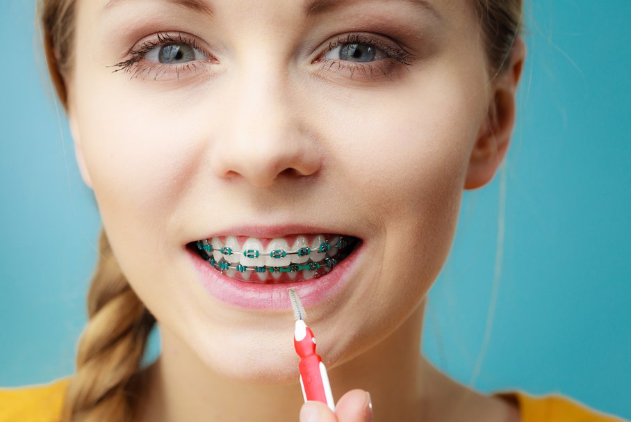 Aparat ortodontyczny – rodzaje, budowa, zakładanie, efekty, czyszczenie, cena, NFZ, opinie