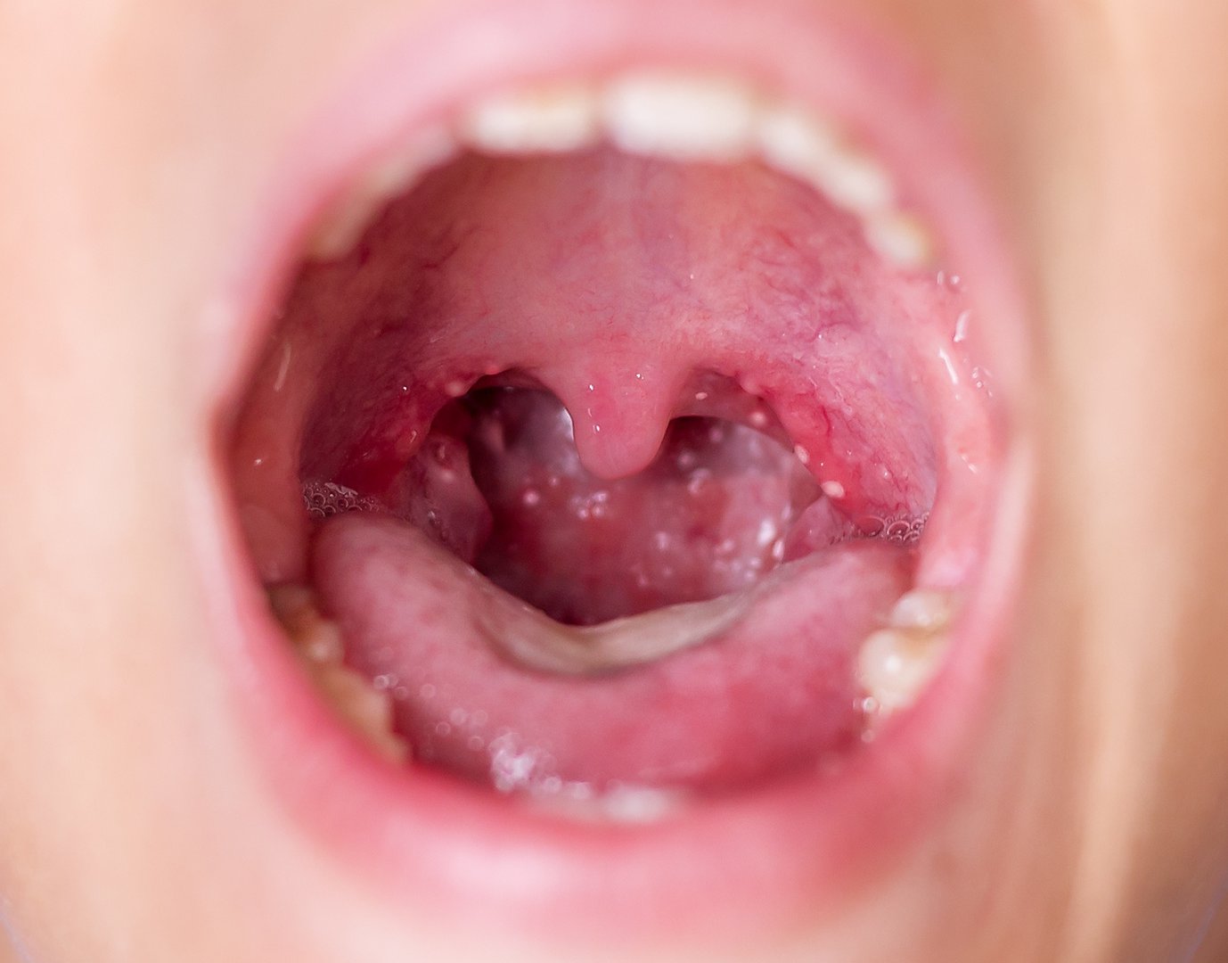 Choroba Bostonska Choroba Dloni Stop I Jamy Ustnej Przyczyny Objawy Leczenie Wylecz To
