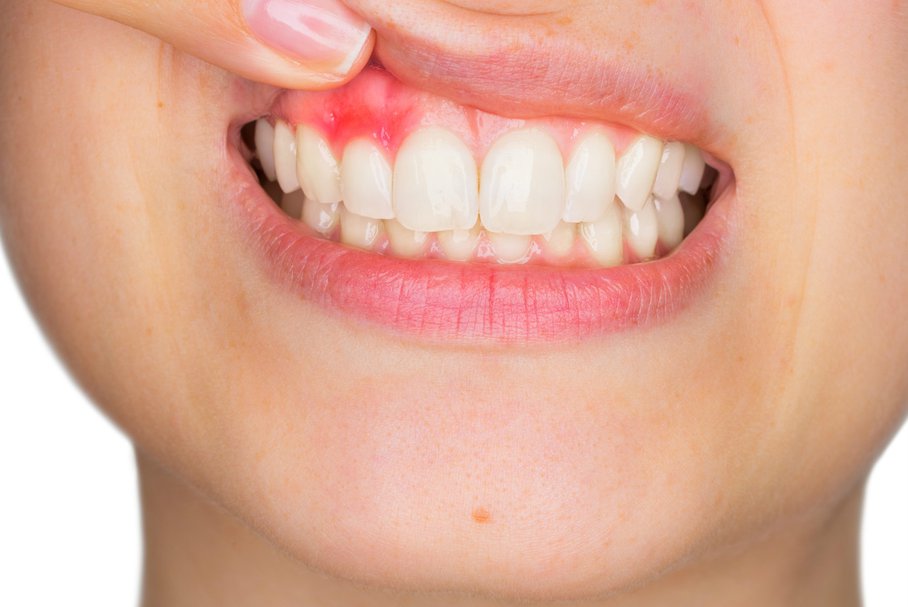 Nadżerki w jamie ustnej – jakie są przyczyny nadżerek w ustach?