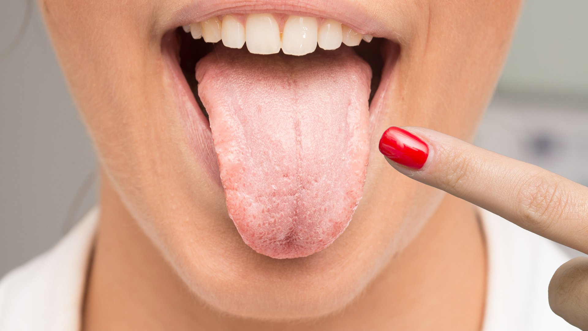 Слюновыделение во рту. Бактериальный глоссит. Десквамативный глоссит языка.