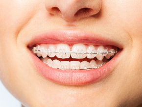 Aparat Clear Aligner – zalety i wady