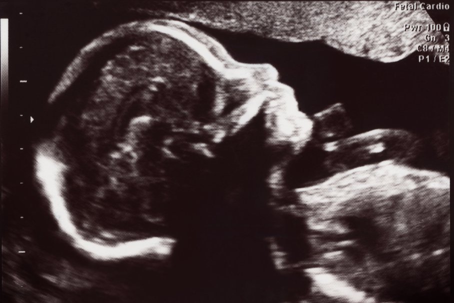 26 Tydzien Ciazy Wylecz To W tym tygodniu sie nie rozpisze, bo choroba zabrala mi wiekszośc sil witalnych. 26 tydzien ciazy wylecz to