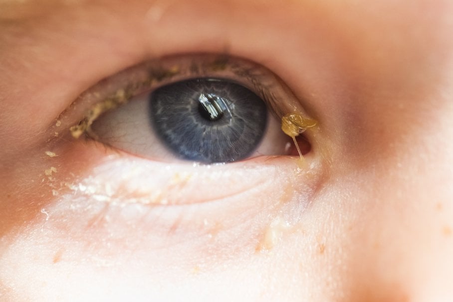 Ropiejące oczy u dziecka – jakie są przyczyny, co robić, czym przemywać?
