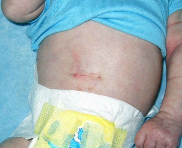 Zwężenie odźwiernika u niemowląt i dorosłych – objawy i leczenie