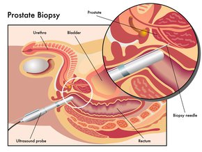 biopsja prostaty