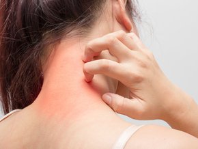 Dermatillomania